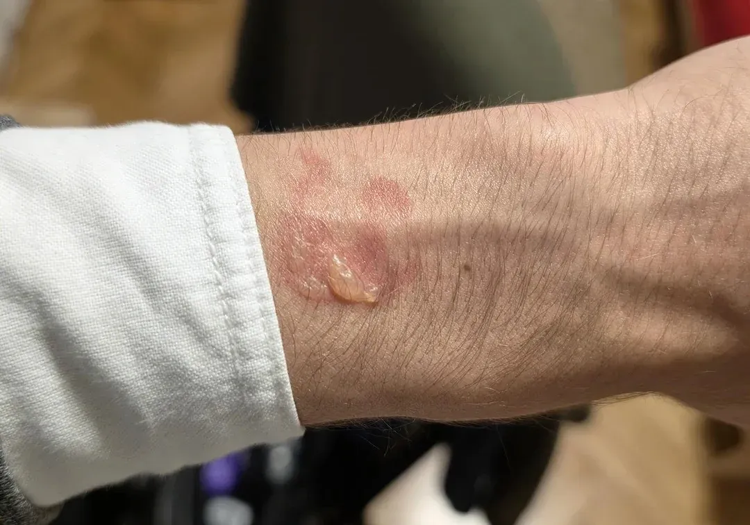 Bekas luka bakar di tangan akibat overheat Samsung Galaxy Watch 5 Pro